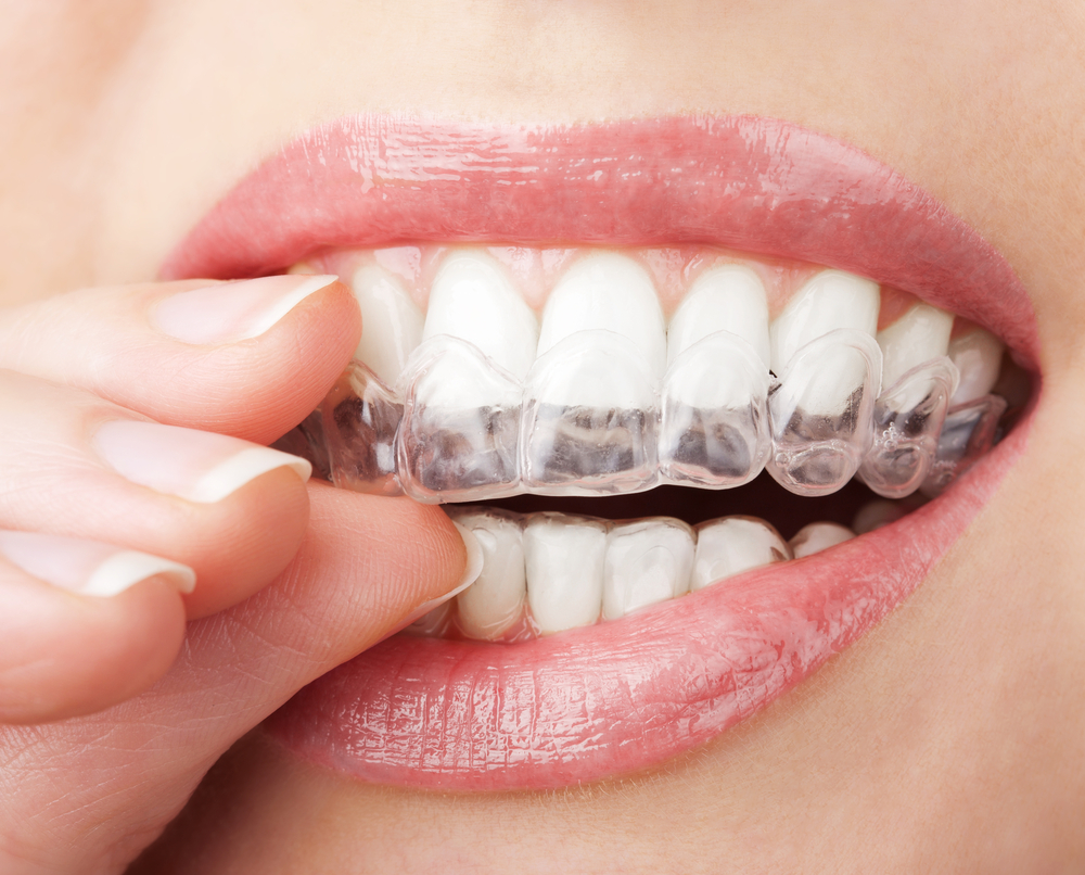 Her er alt, hvad du skal vide om tandblegning